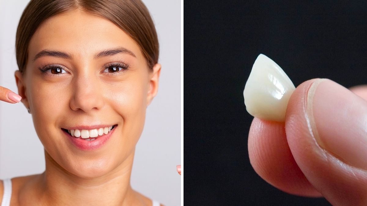 aligneurs dentaires maison